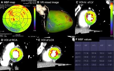 Diagnostic efficacy of absolute and relative myocardial blood flow of stress dynamic CT myocardial perfusion for detecting myocardial ischemia in patients with hemodynamically significant coronary artery disease
